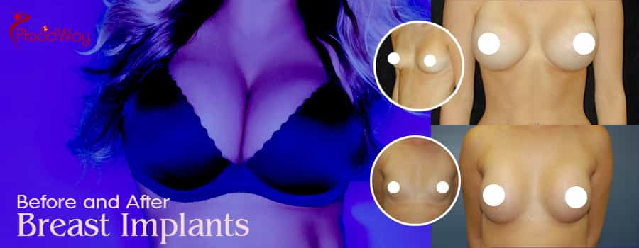 B & A Breast Implants in Antalya, Turkey